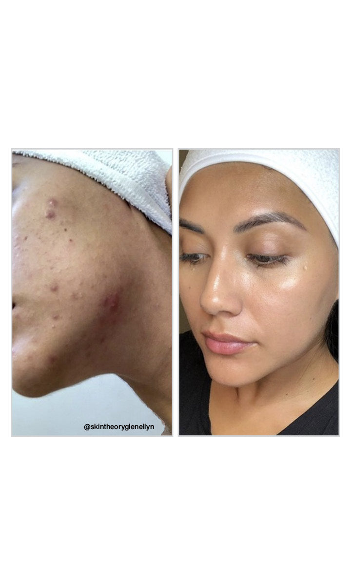Vivant 8% Mandelic Acid Serum