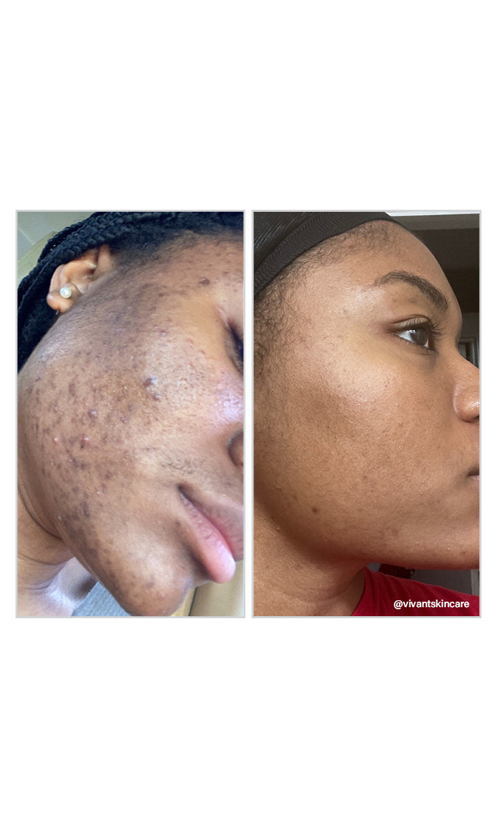 Vivant 8% Mandelic Acid Serum