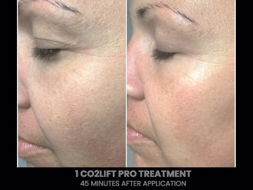 CO2Lift Pro Carboxy Gel Treatment - 3 Treatments