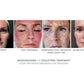 CO2Lift Pro Carboxy Gel Treatment - 3 Treatments