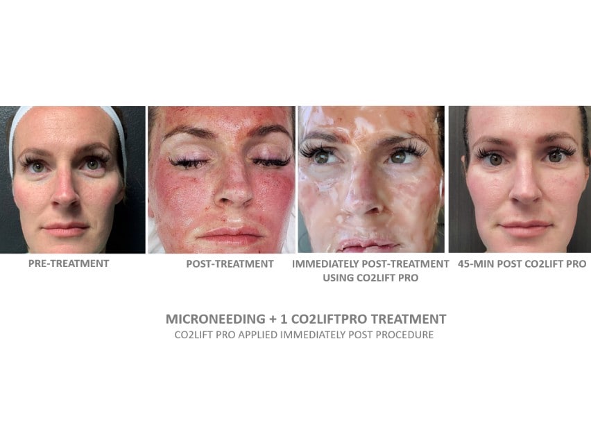 CO2Lift Pro Carboxy Gel Treatment - 3 Treatments