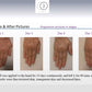CO2Lift Pro Carboxy Gel Treatment - 3 Treatments