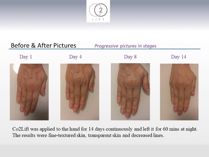 CO2Lift Pro Carboxy Gel Treatment - 3 Treatments
