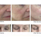CO2Lift Pro Carboxy Gel Treatment - 3 Treatments