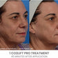 CO2Lift Pro Carboxy Gel Treatment - 3 Treatments