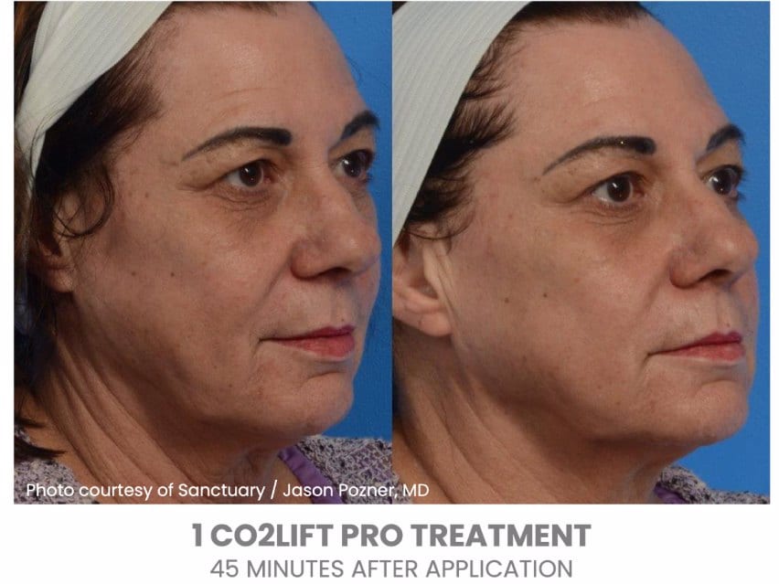 CO2Lift Pro Carboxy Gel Treatment - 3 Treatments