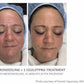CO2Lift Pro Carboxy Gel Treatment - 3 Treatments