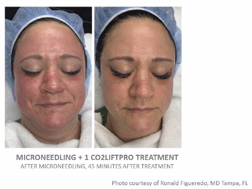 CO2Lift Pro Carboxy Gel Treatment - 3 Treatments
