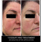 CO2Lift Pro Carboxy Gel Treatment - 3 Treatments
