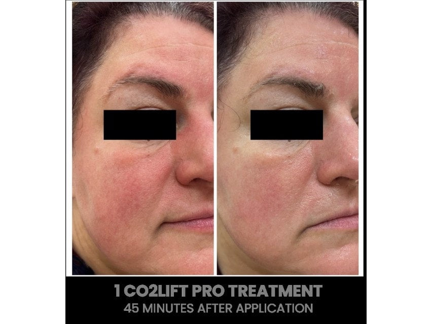CO2Lift Pro Carboxy Gel Treatment - 3 Treatments